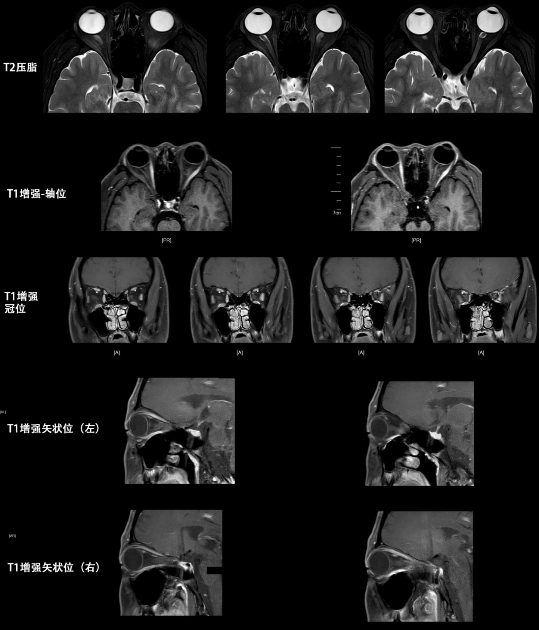 视神经管ct扫描范围图片