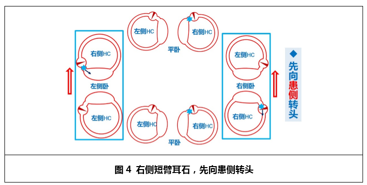 你见过这些不典型的水平半规管bppv吗?丨晕筹帷幄