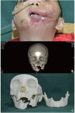 瘢痕,局部创口处见唾液储留;左侧面下1/3见大面积软组织和部分下颌骨