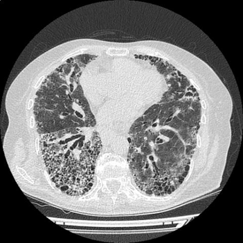 肺纤维化片子图片