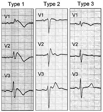 高钾的心电图三个特征图片