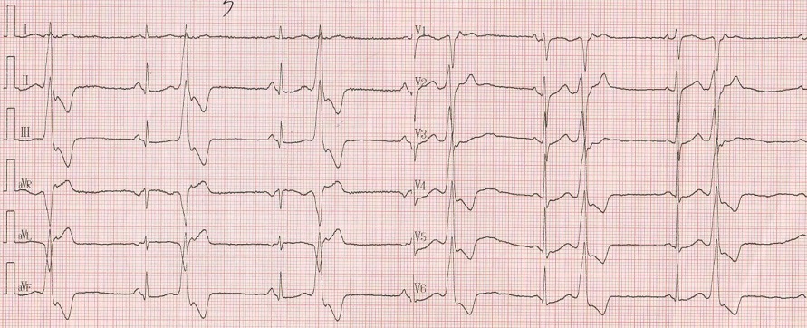 多源性室早心电图图片图片