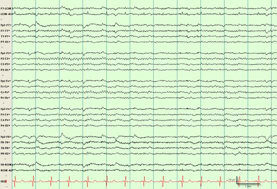 脑电波图 正常图片