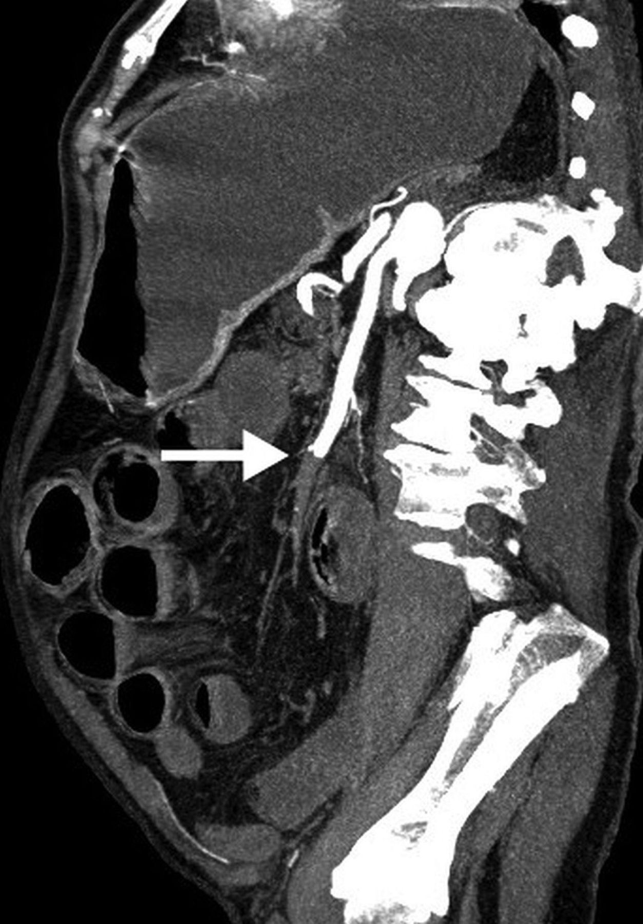 cta显示肠系膜上动脉中段完全闭塞