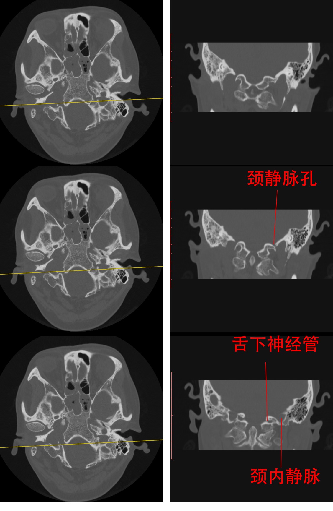 除了schmidt syndrome以外,只有颈静脉孔综合征(vernet syndrome)是不