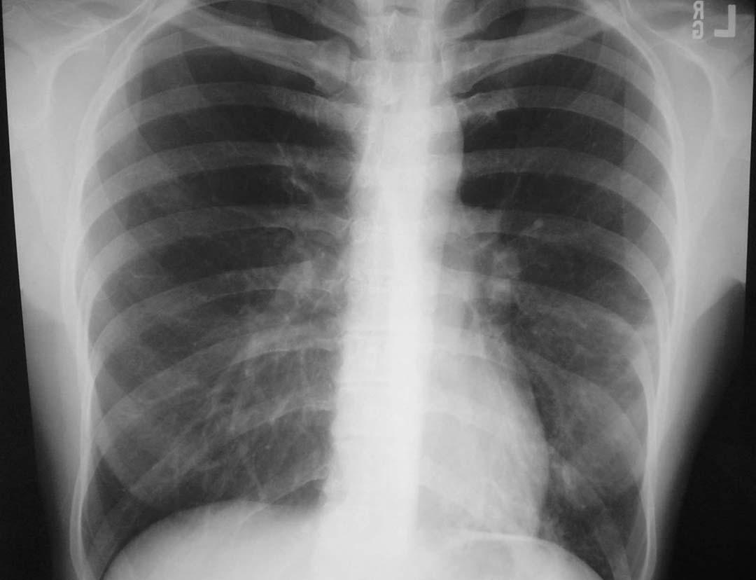 肺炎胸片图片图片