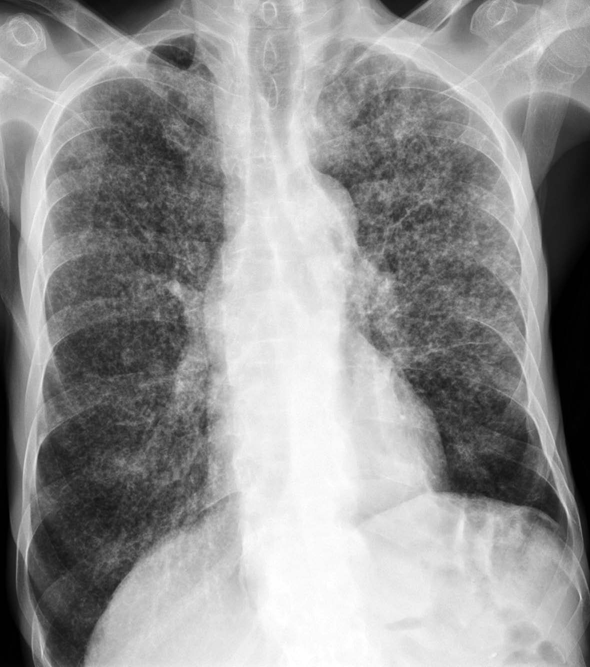 典型双肺粟粒性肺结核一例