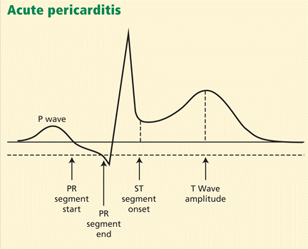 心电图分辨stemi与急性心包炎的5个要点丨急诊心事