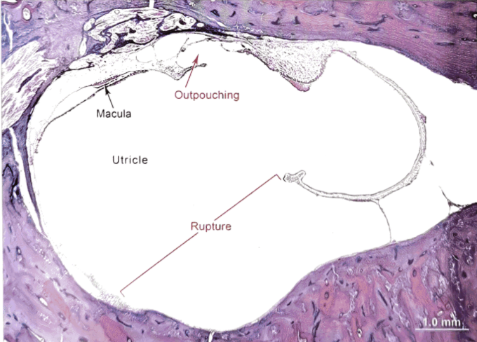 22张图,细说梅尼埃病的组织病理学特点丨"晕"筹帷幄