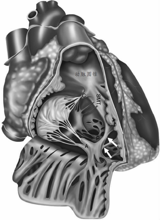 肺动脉圆锥部图片