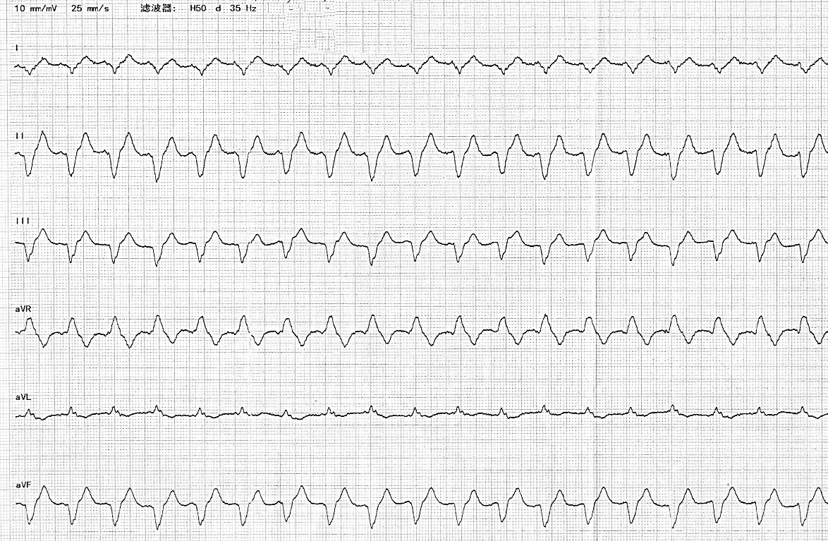 家兔高钾血症心电图图片