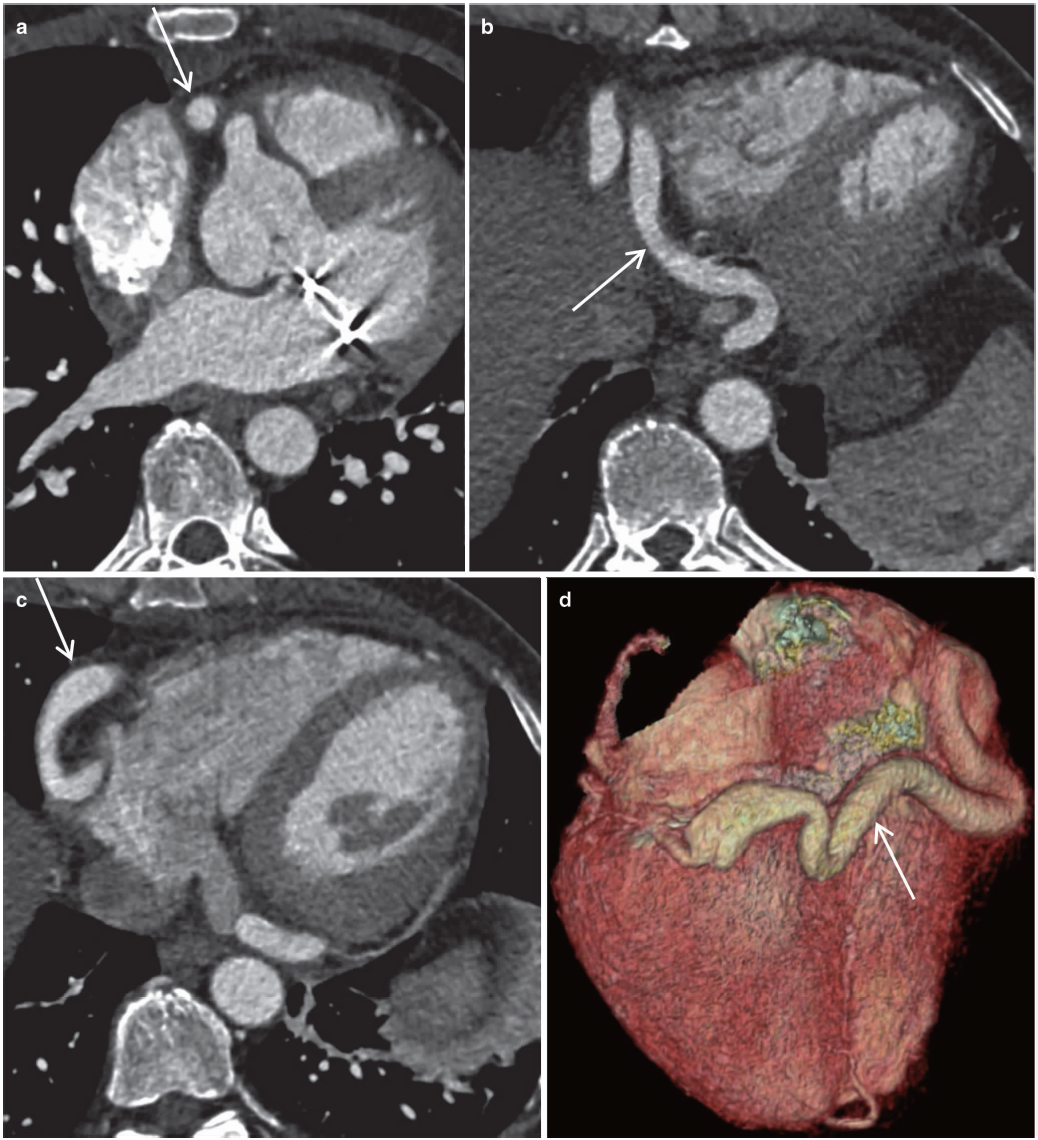 正常心脏大血管EBCT增强扫描影像学表现-医学影像图,_医学图库