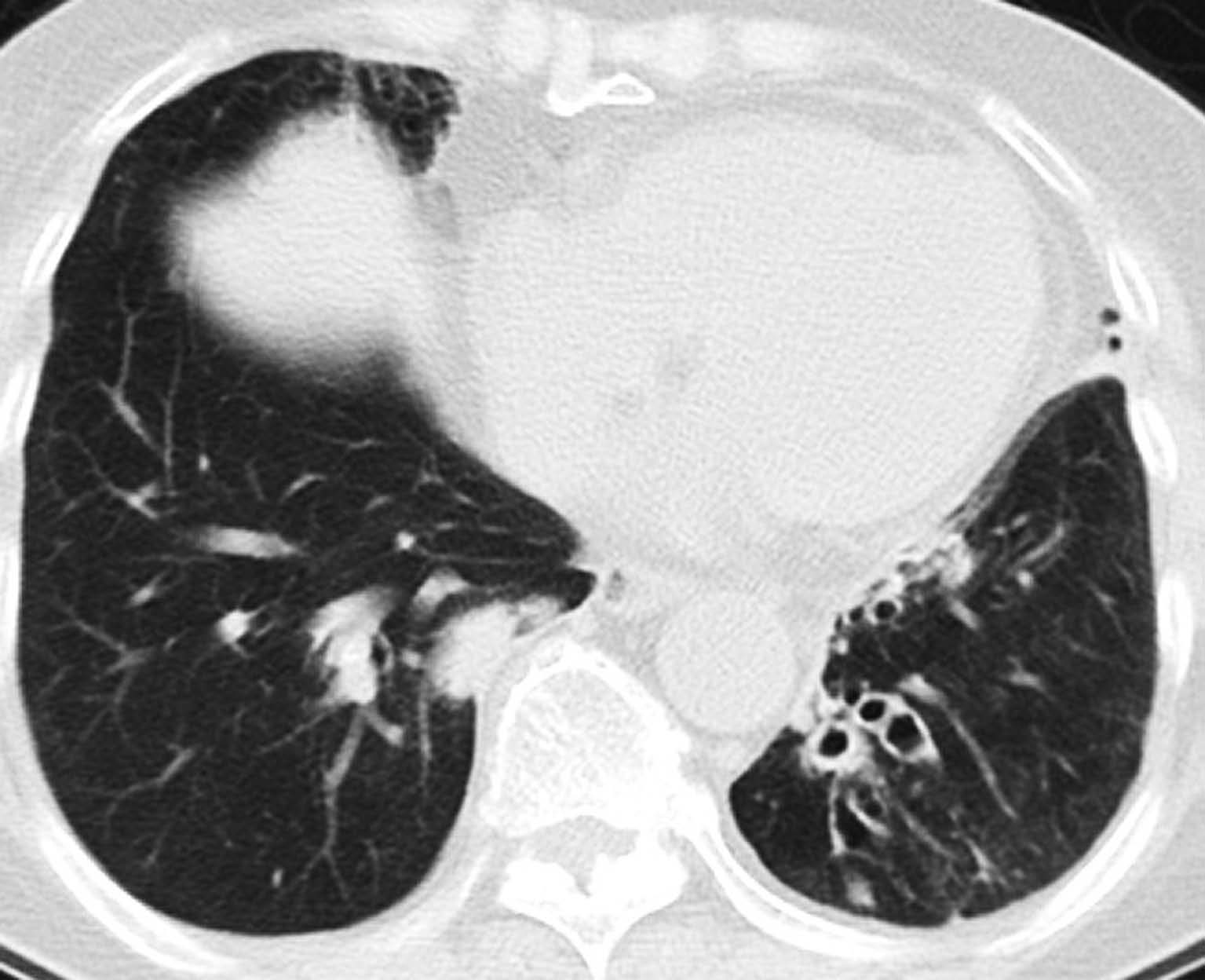 E诊断：肺气肿的影像表现及图像