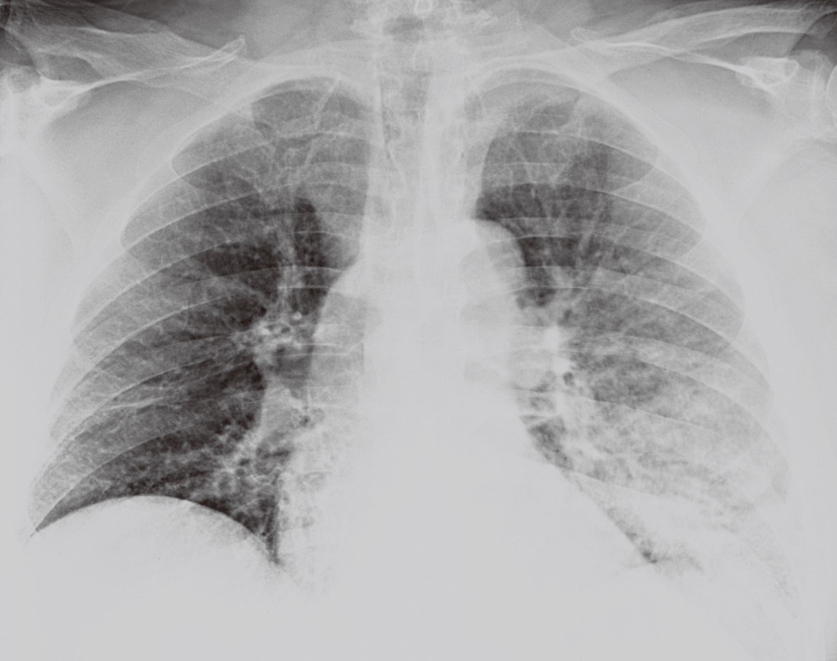 图2—35 亚急性血行播散性肺结核-胸部X线影像学图鉴-医学