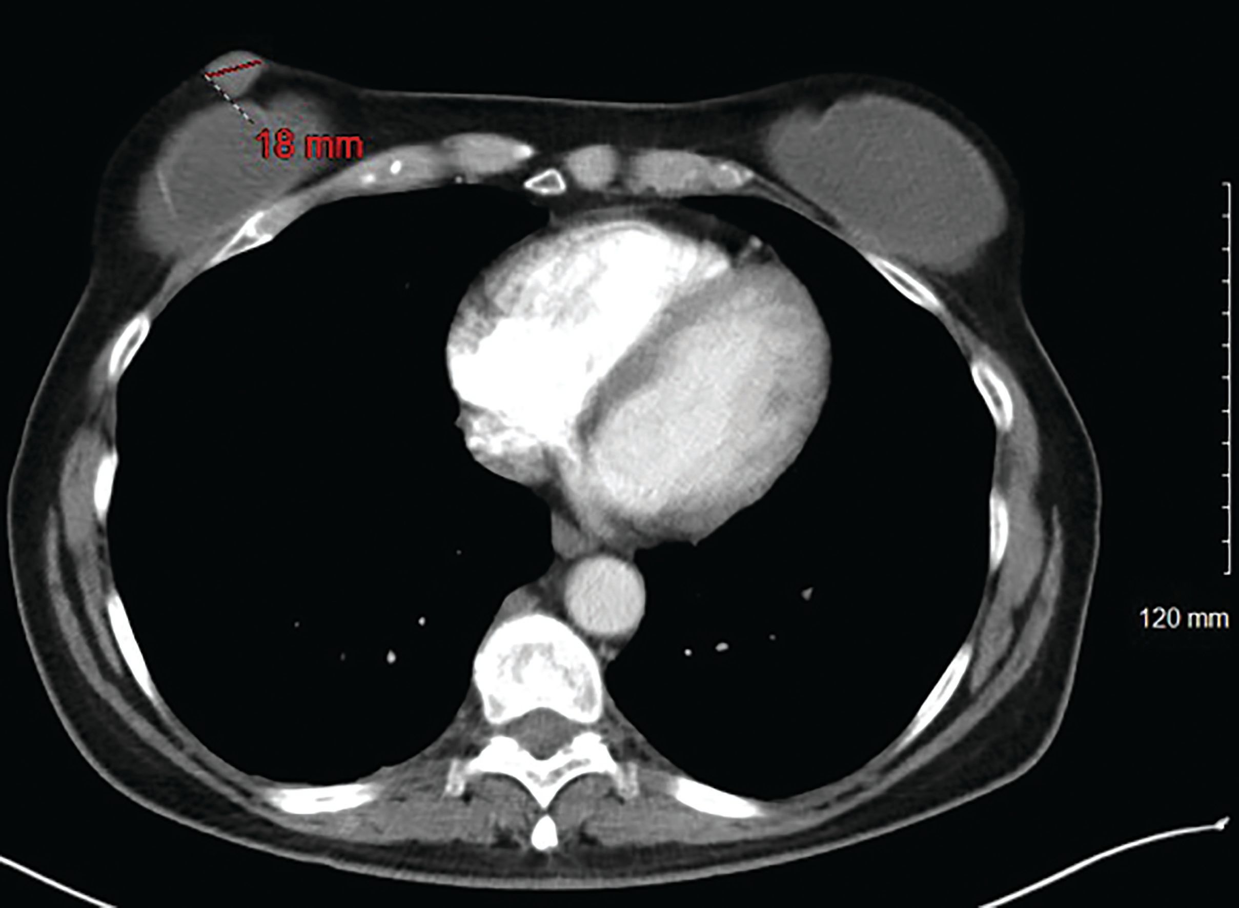 三、螺旋CT在胸部疾病诊断中的应用-胸部CT-医学
