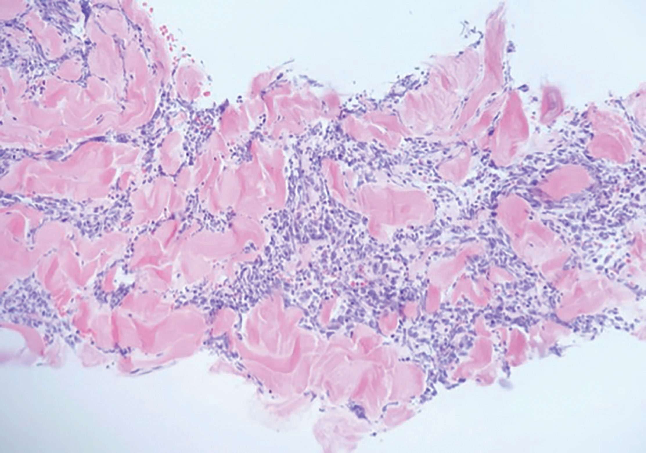 三阴性乳腺癌的分子及免疫标记特征 - 乳腺肿瘤学 - 天山医学院