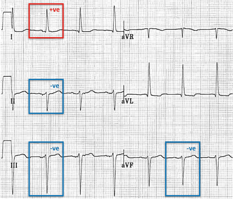 3种电轴左偏的心电图模式,你都见过吗?