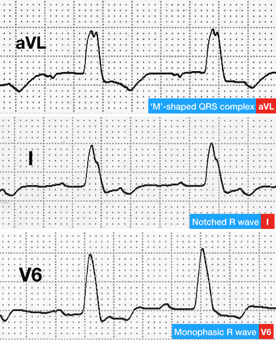 3种电轴左偏的心电图模式,你都见过吗?