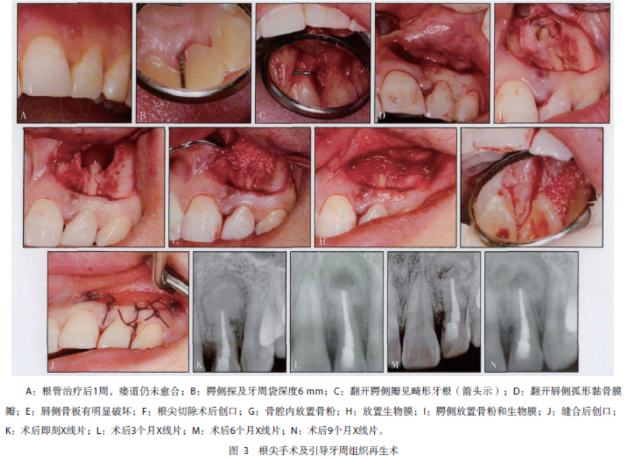 左上侧切牙Ⅲ型牙内陷牙髓及牙周联合治疗1例