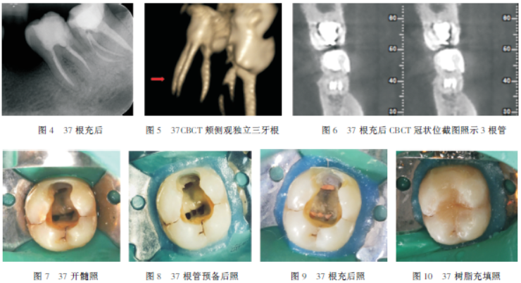 下颌第二磨牙3牙根伴近中3根管病例分析