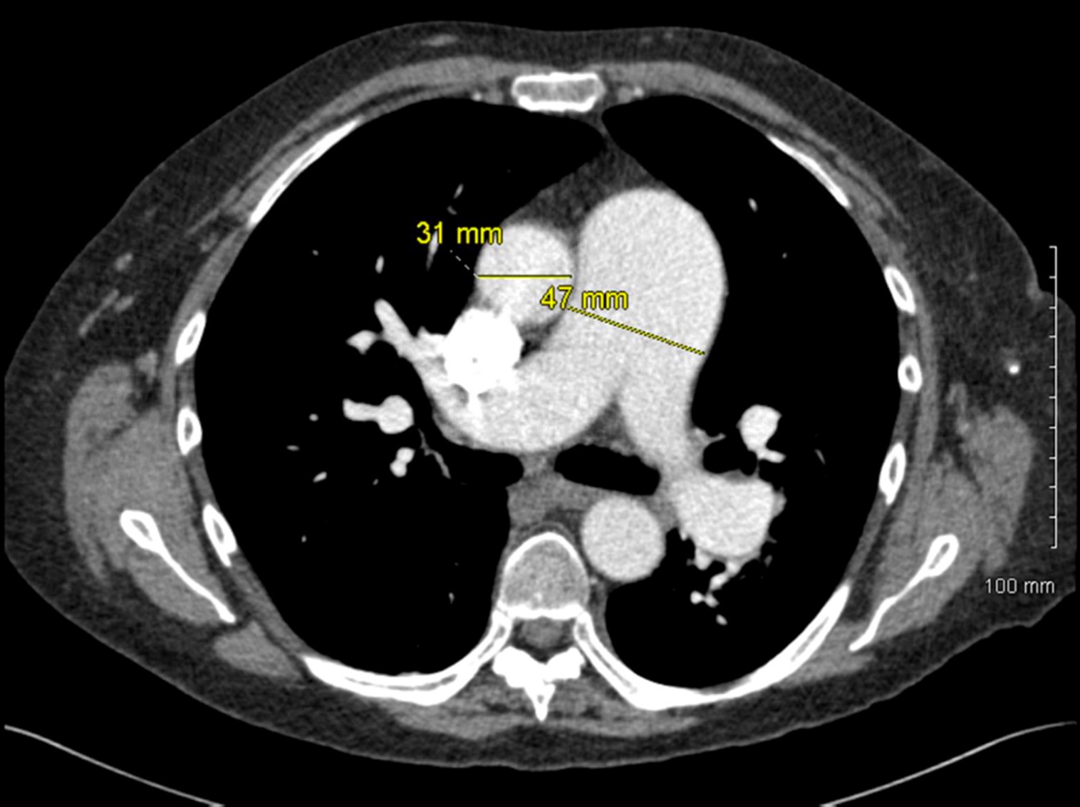 肺动脉段膨隆图片