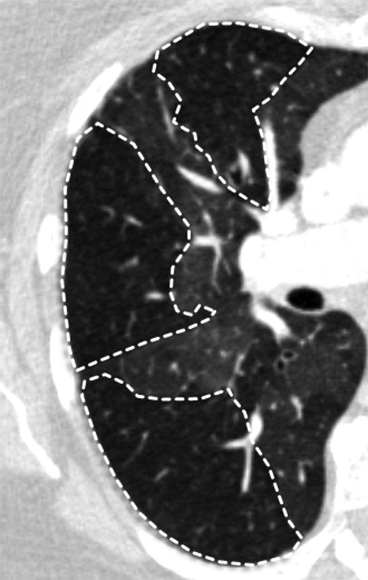 肺动脉高压残根征图片图片