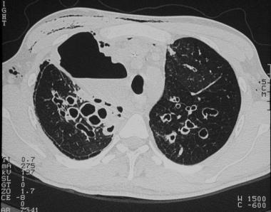 一文总结囊性纤维化的肺部影像学特征