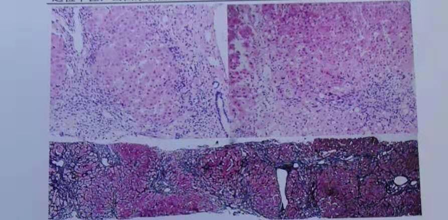 病理诊断:(肝穿)中度小叶性肝炎(多数新旧不一的桥接坏死带)符合aih