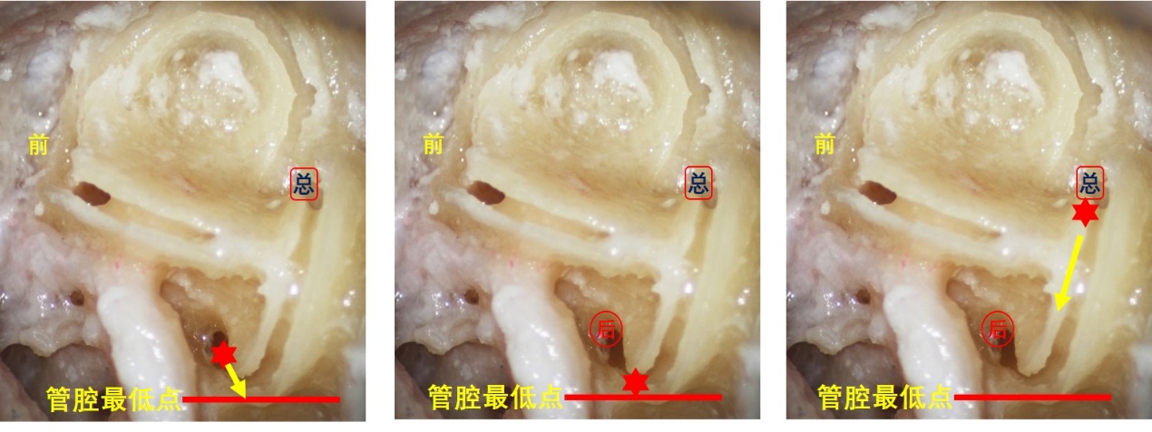 有图有视频:后半规管bppv的眼震机制(v20)丨晕筹帷幄