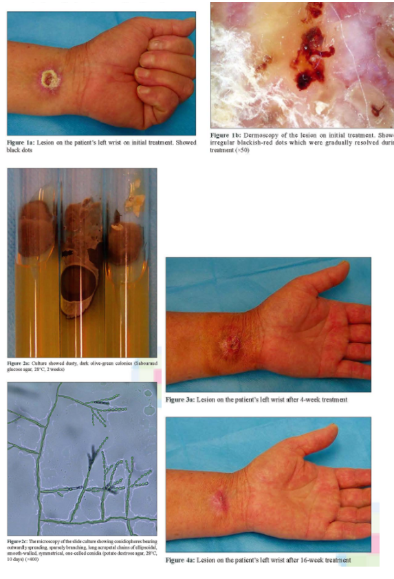 孢子丝菌病图片手指图片