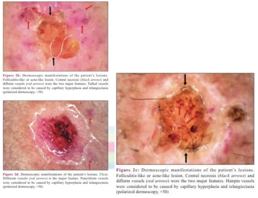 马尔尼菲篮状菌皮疹图片