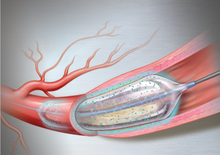 过度增殖的药物(紫杉醇),然后输送至冠脉狭窄处,球囊扩张紧贴血管壁