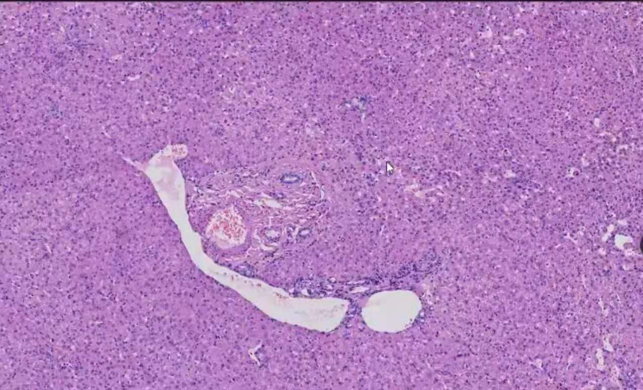 门脉性肝硬化镜下图片图片