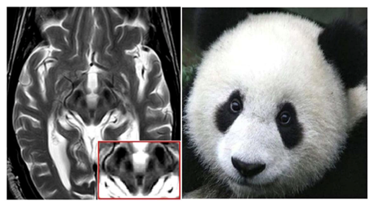 神经科的熊猫眼,你了解多少?