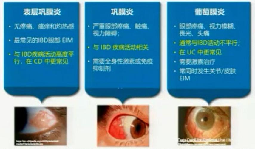 图3  ibd常见眼部病变表层巩膜炎:特征是单眼或双眼急性充血伴有轻度