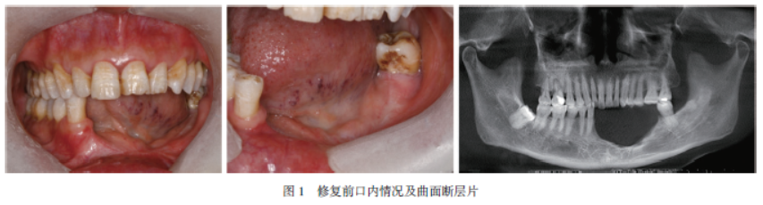 牙槽骨手术失败图片图片