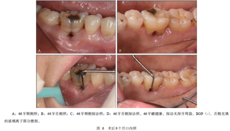 下颌第一磨牙根分叉病变治疗随访27年1例