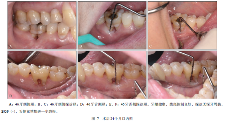 下颌第一磨牙根分叉病变治疗随访27年1例