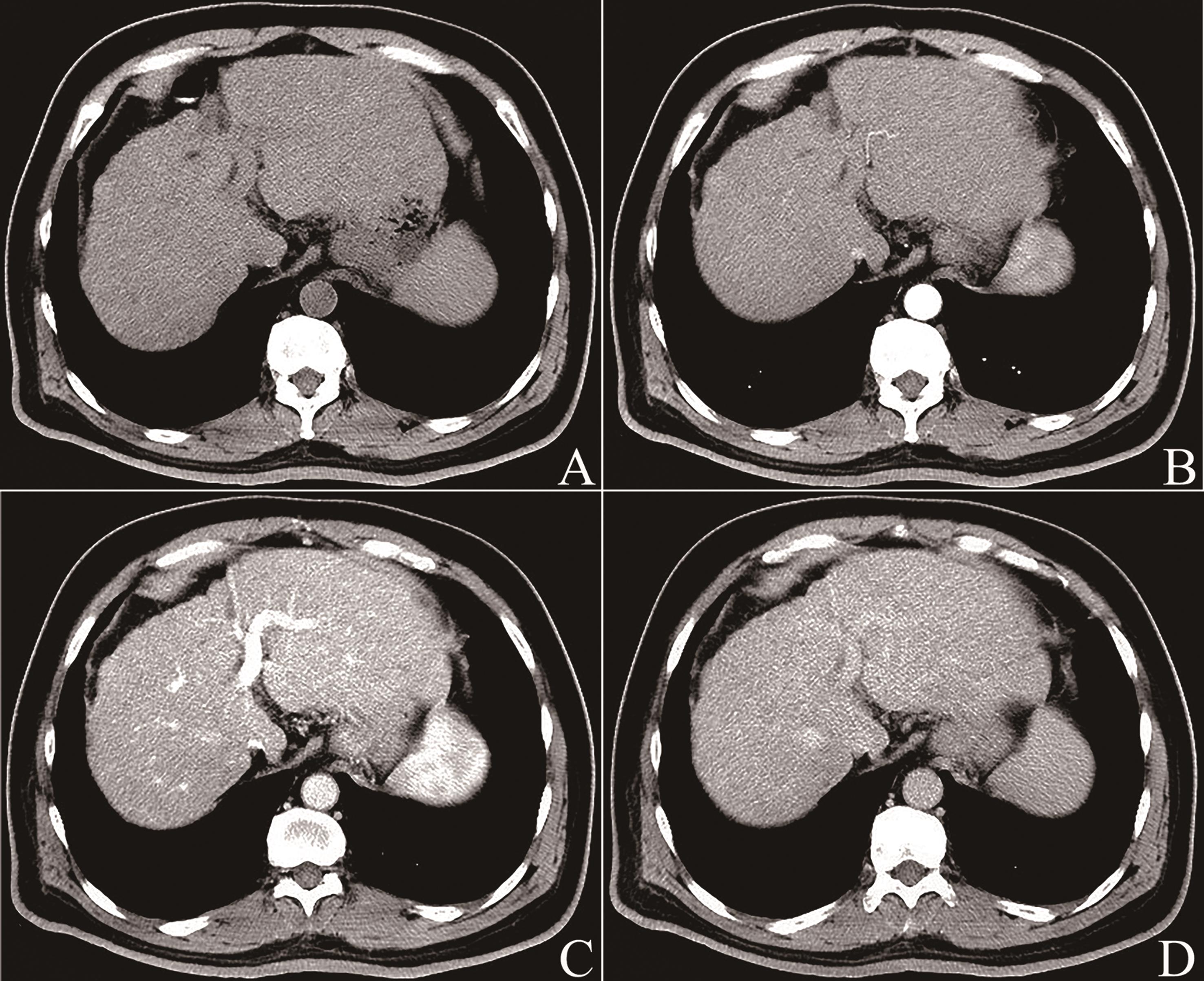 罕见的肝硬化巨大结节影像学如何诊断病例学习