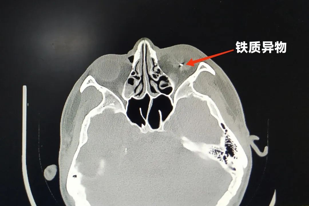 新生儿月牙状角巩膜缘图片
