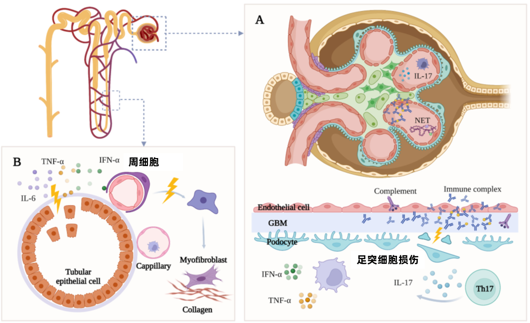 a炎症环境和免疫复合物沉积导致足细胞