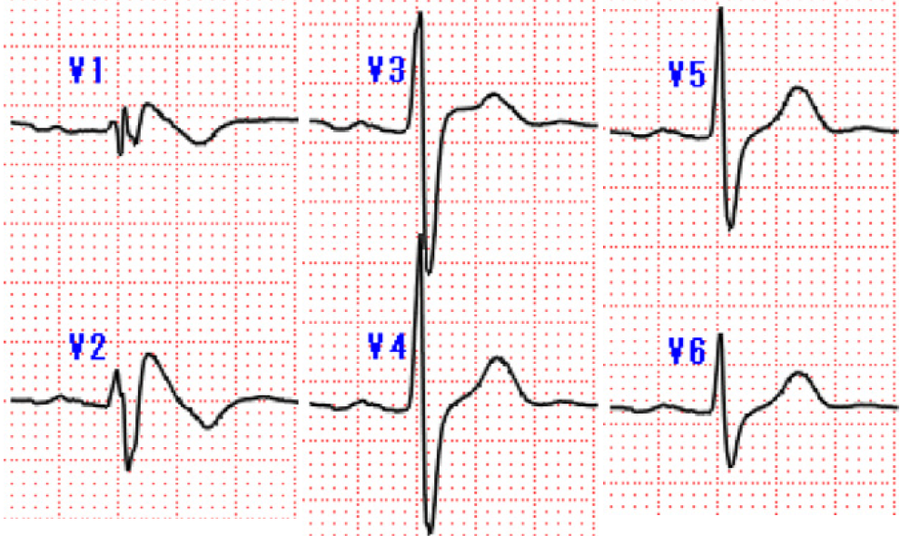 在具有1型brugada心电图模式的st段抬高患者中可诊断brs,其特征为≥1