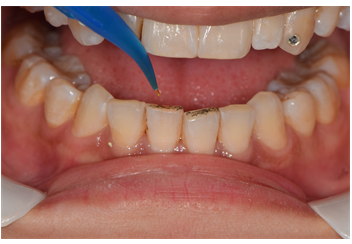 nd:yag激光联合氟化钠治疗牙本质敏感一例及文献回顾