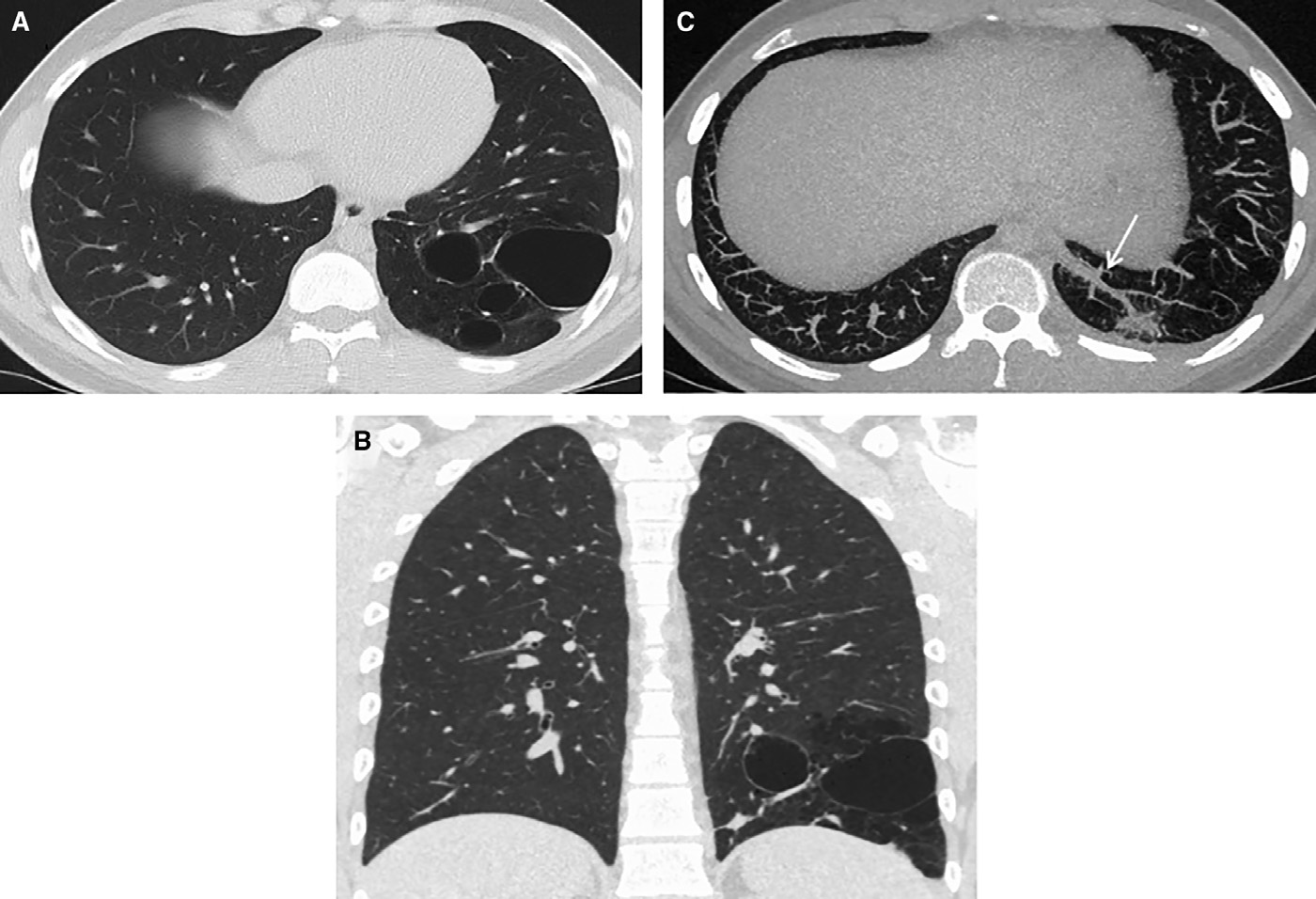 肺脓肿1例