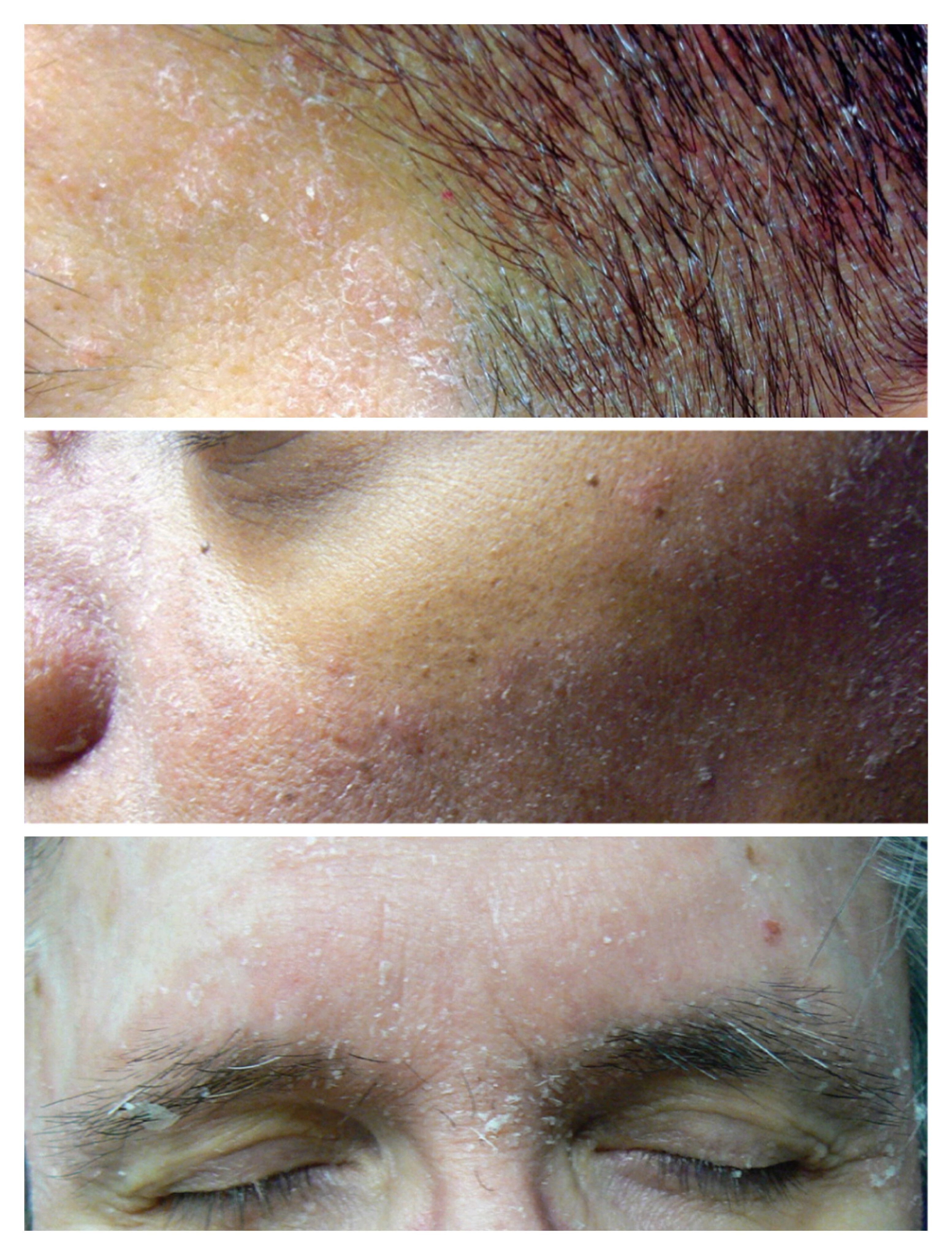 面部脂溢性皮炎如何修护与后期保养？ - 知乎