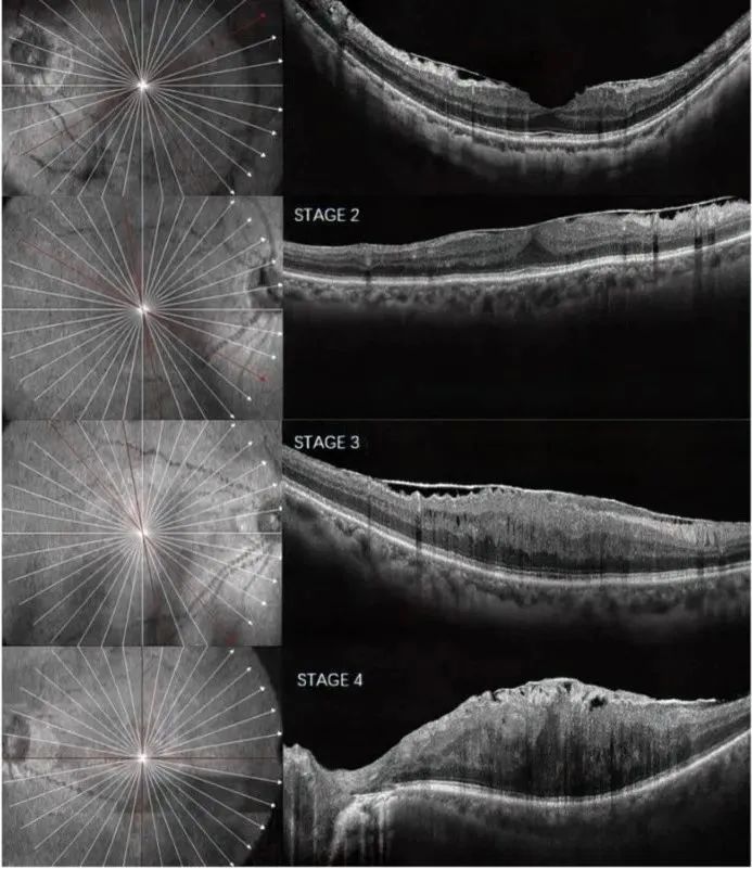视网膜分层oct图片
