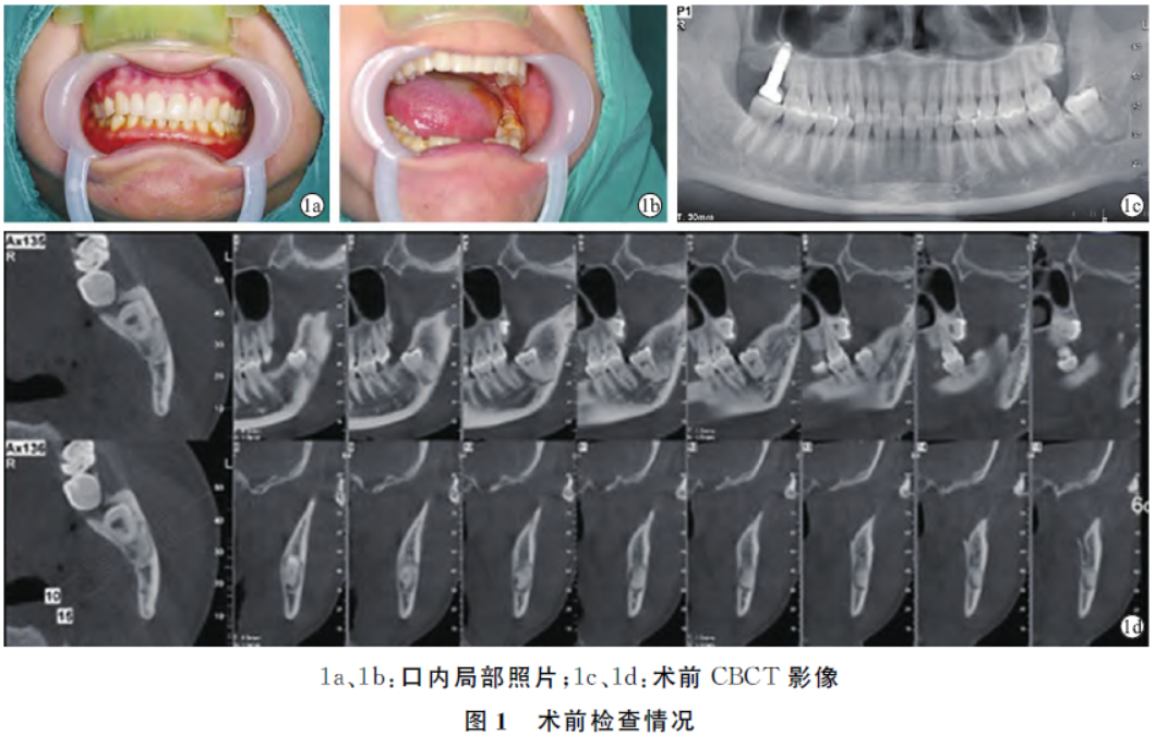 左下颌埋伏阻生智齿伴根尖成牙骨质细胞瘤微创手术1例
